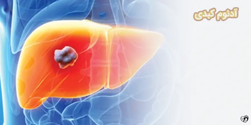 Hepatic Adenoma آدنوم کبدی