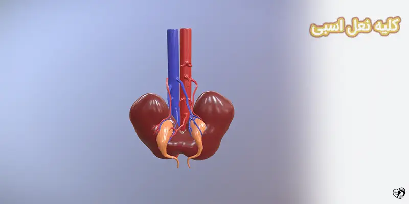 Horseshoe Kidney کلیه نعل اسبی