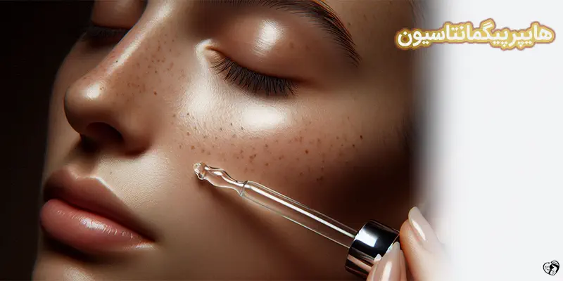 Hyperpigmentation هایپرپیگمانتاسیون