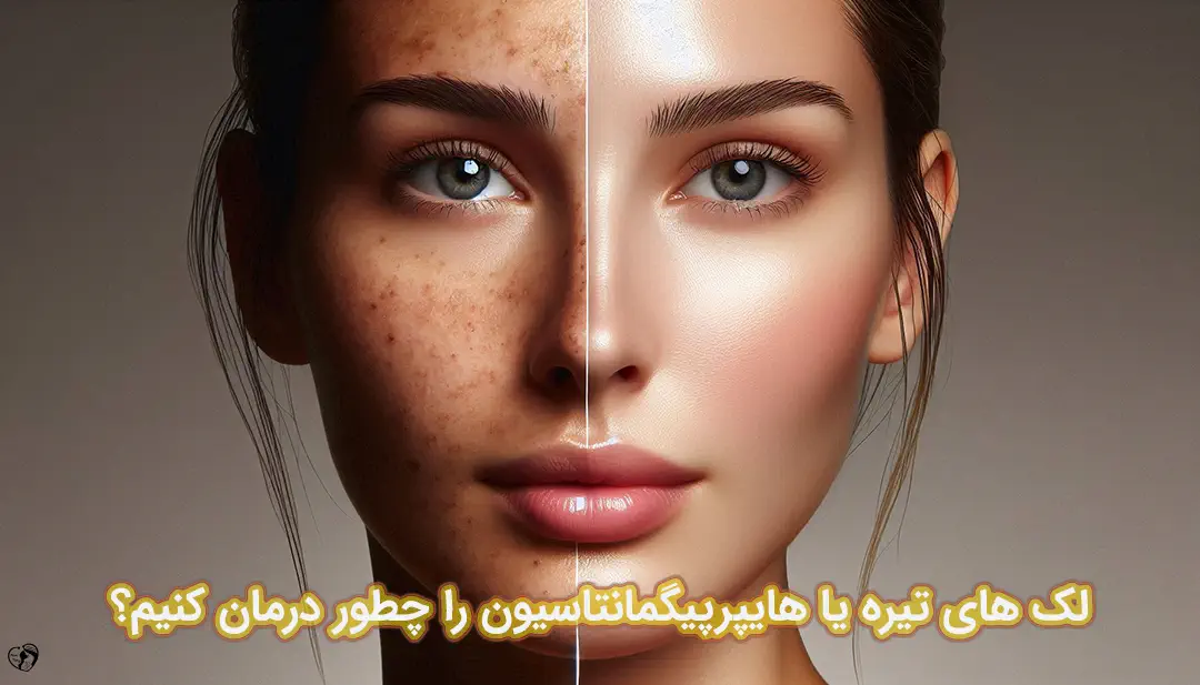 هایپرپیگمانتاسیون