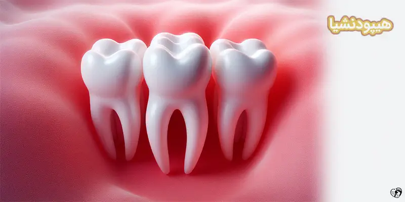 Hypodontia Missing Teeth1 هیپودنشیا