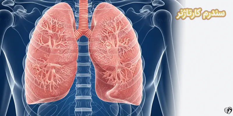 Kartagener Syndrome سندرم کارتاژنر