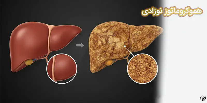 Neonatal Hemochromatosis هموکروماتوز نوزادی