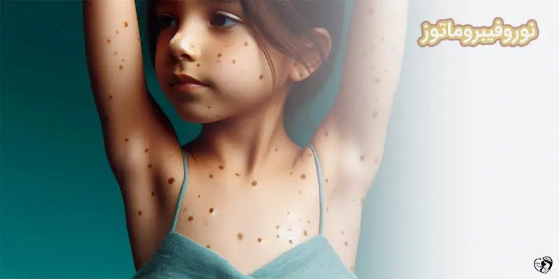 نوروفیبروماتوز