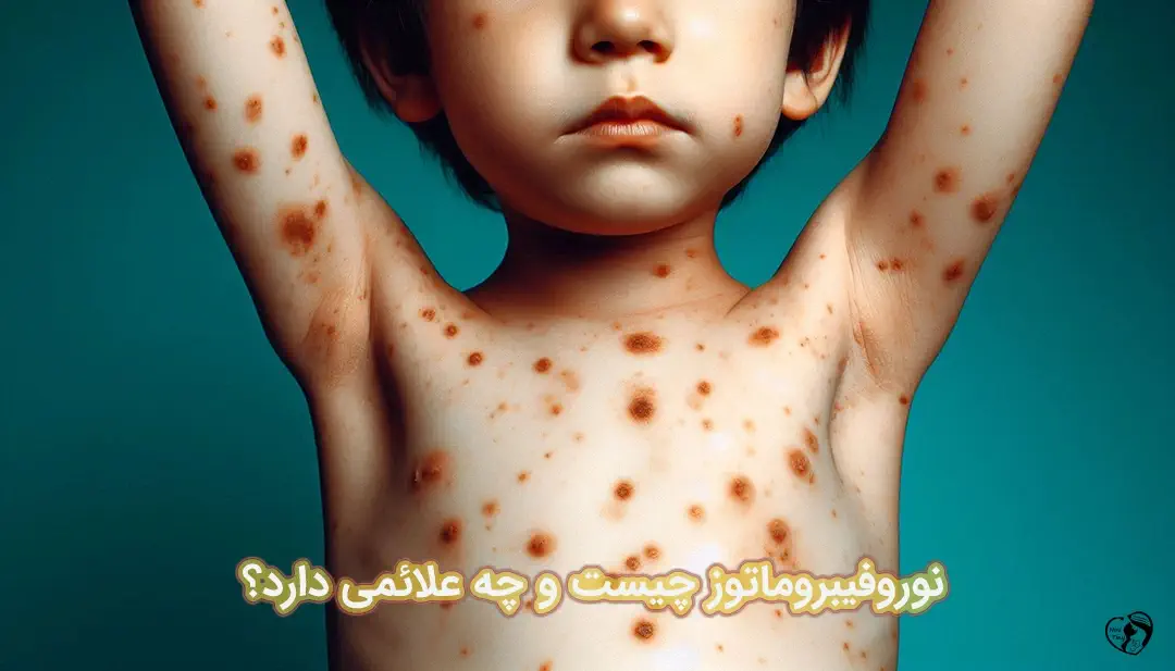 نوروفیبروماتوز