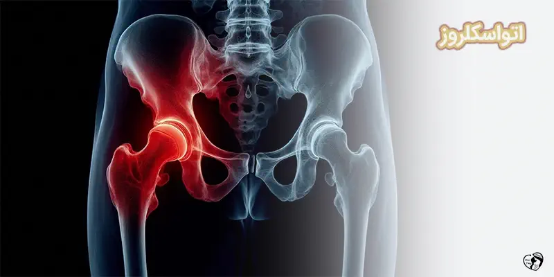 Otosclerosis اتواسکلروز