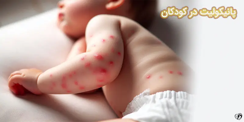 Panniculitis پانیکولیت در کودکان