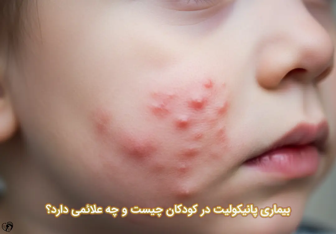 پانیکولیت در کودکان پانیکولیت در کودکان