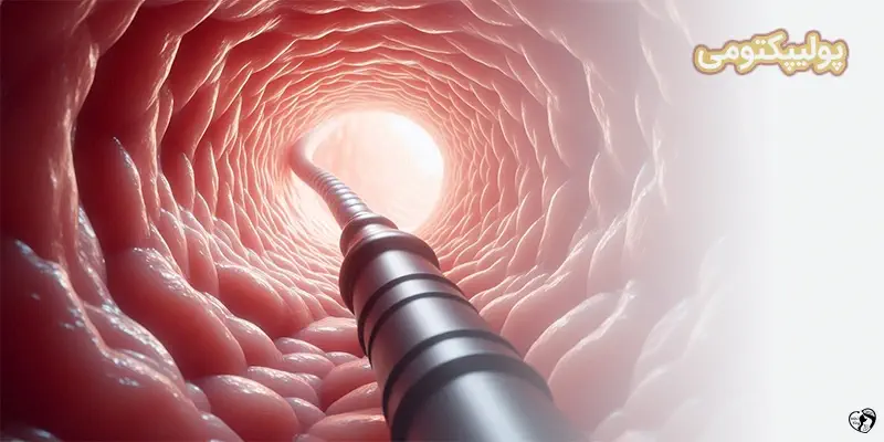 Polypectomy پولیپکتومی