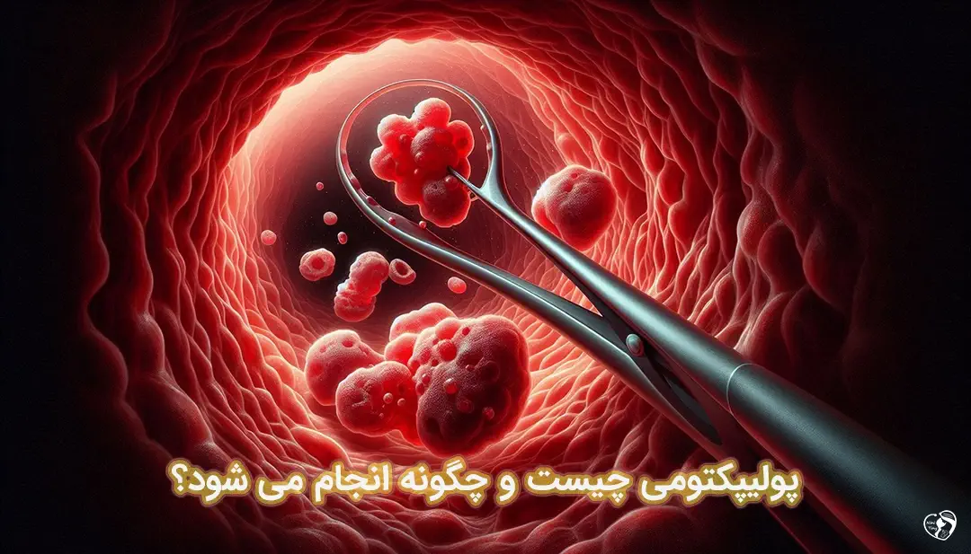 پولیپکتومی پولیپکتومی