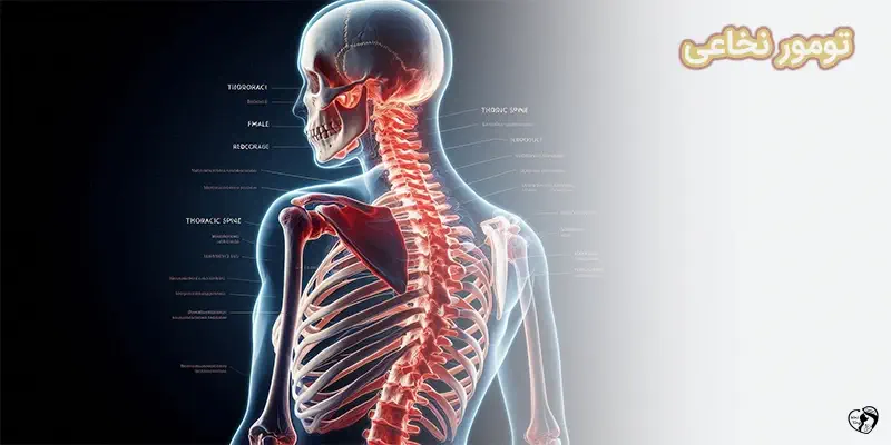 تومور نخاعی