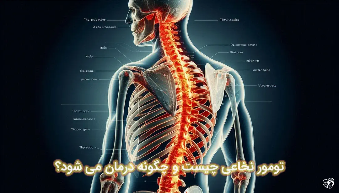 تومور نخاعی