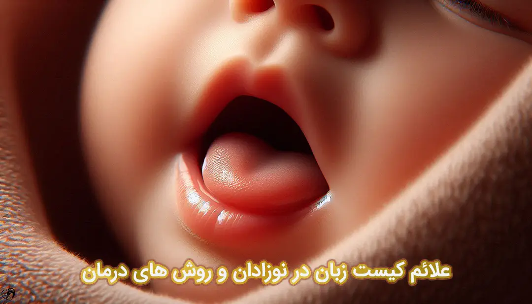 کیست زبان در نوزادان