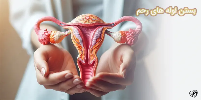 Tubal Ligation بستن لوله های رحم