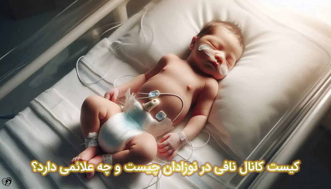 کیست کانال نافی در نوزادان